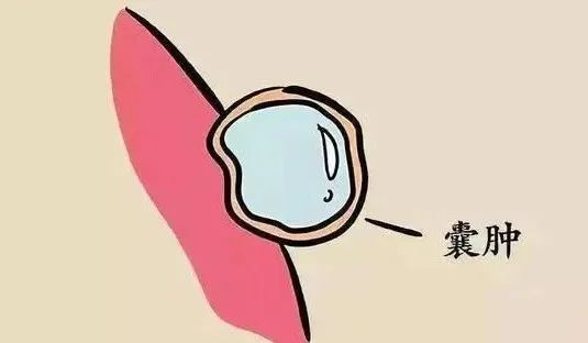 肾囊肿：4个特效方