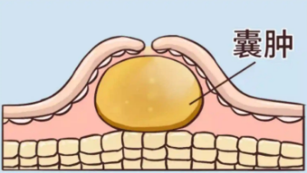 肝囊肿，就用这个消囊特效方
