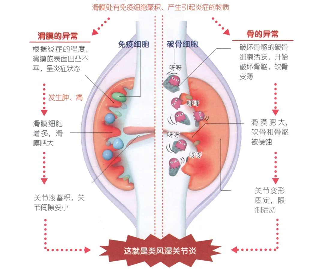 类风湿关节炎如何快、准、狠的治疗？