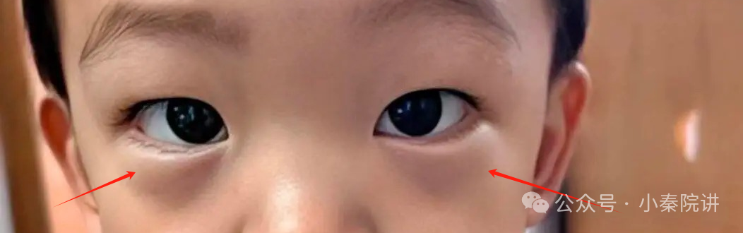 一张小方治愈小儿眼袋