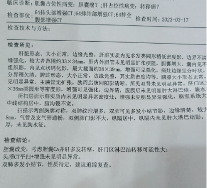中醫介入治療膽囊癌，西醫說真神奇