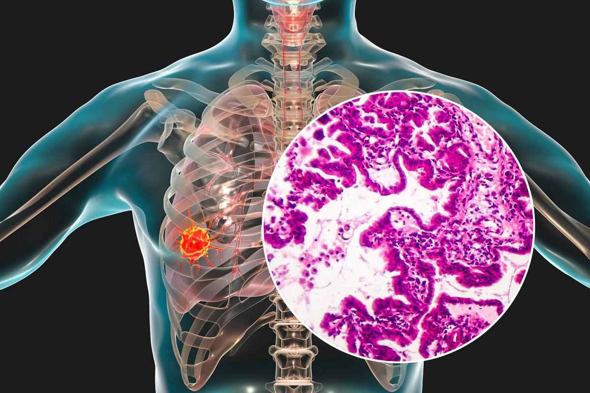 肺癌治疗取得重大进展，肺癌正在变成慢性病！长期生存已成为现实